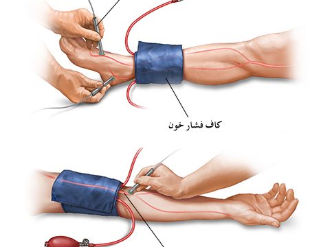 ارزیابی عروق در بیماران دیابتی
