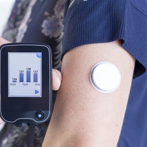 CGM