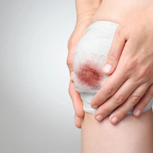 چرا زخم پای دیابتی چرک می‌کند و بوی بد می‌دهد؟