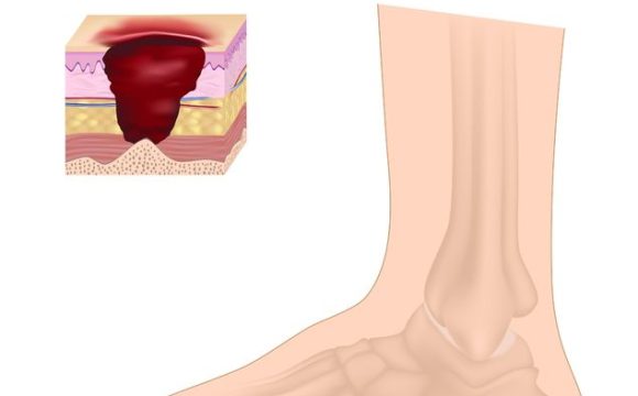 زخم پای دیابتی از کجا شروع میشه؟