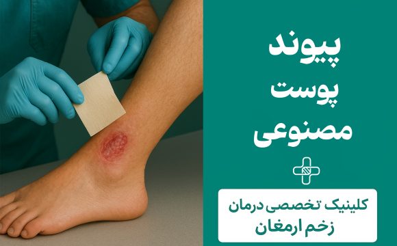 پیوند پوست مصنوعی