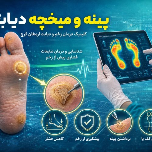 پینه و میخچه در بیماران دیابتی