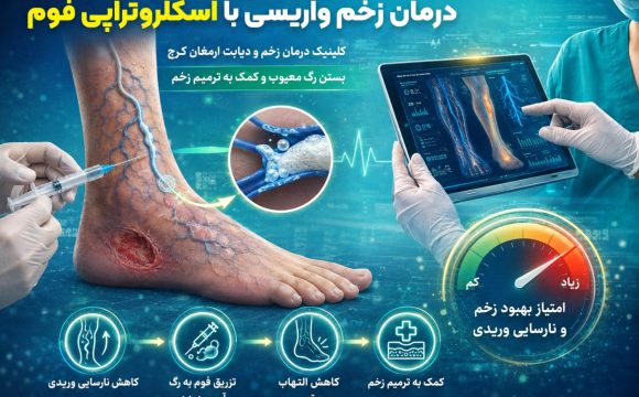 اسکلروتراپی